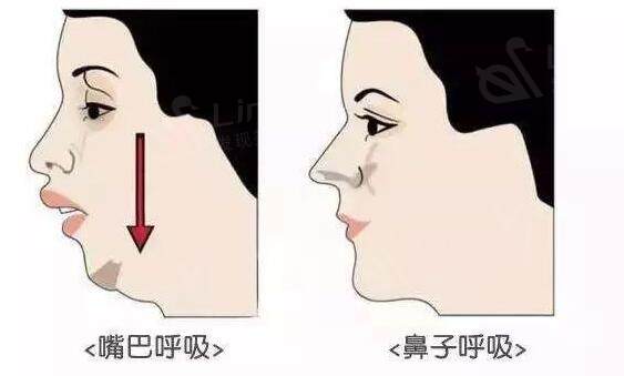 龅牙.jpg