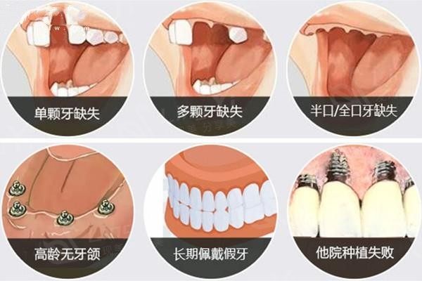 种植体适应人群