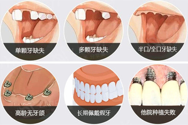 种植体适用人群