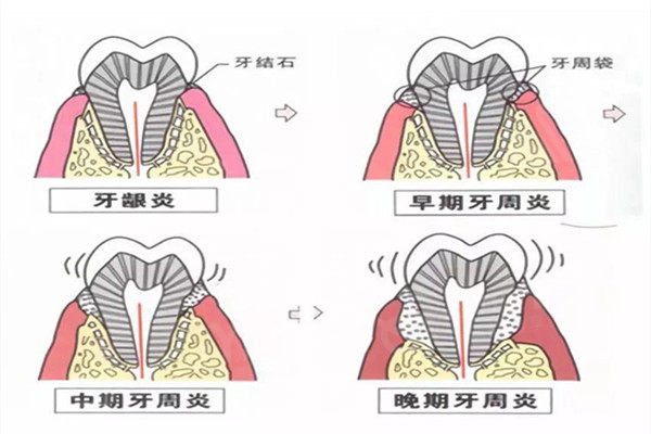 牙龈炎