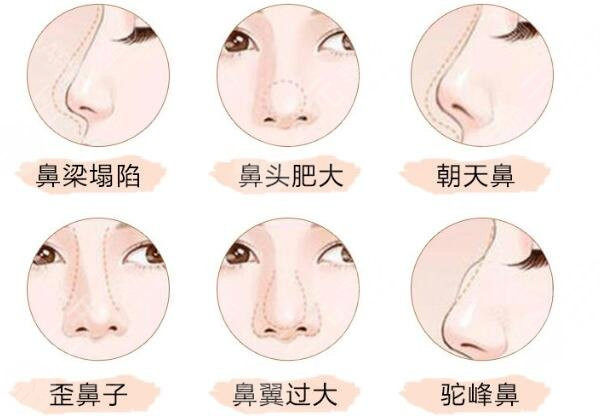 隆鼻的几种情况