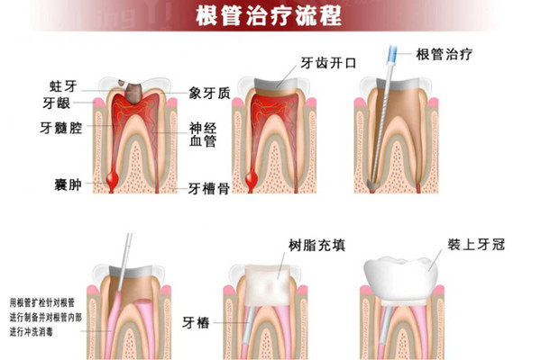 根管治疗