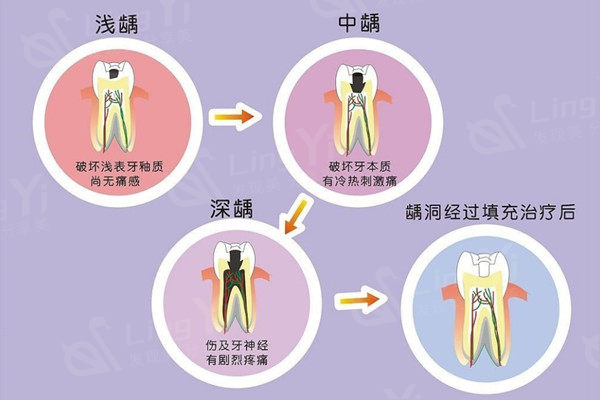 根管治疗