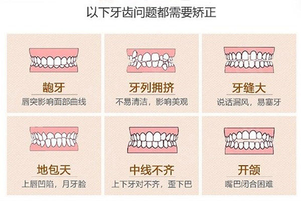 牙齿矫正可以解决的问题
