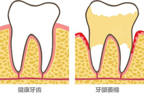 牙龈萎缩牙根外露