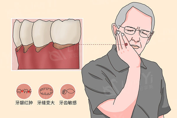 牙龈萎缩牙根外露