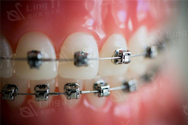 南京口腔医院收费标准：种植牙/牙齿矫正/补牙/拔牙/洗牙要价均罗列还不贵