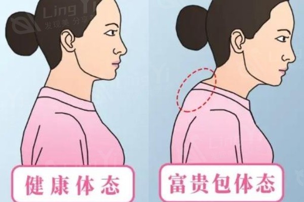 富贵包北京哪里治得好
