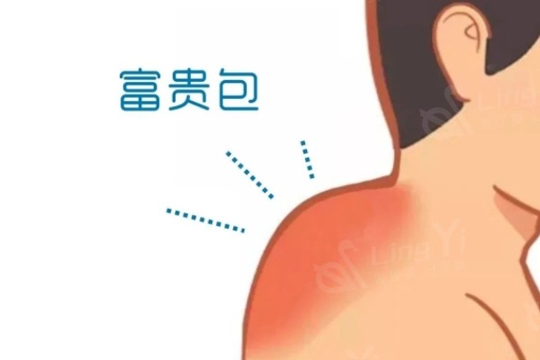 富贵包北京哪里治得好