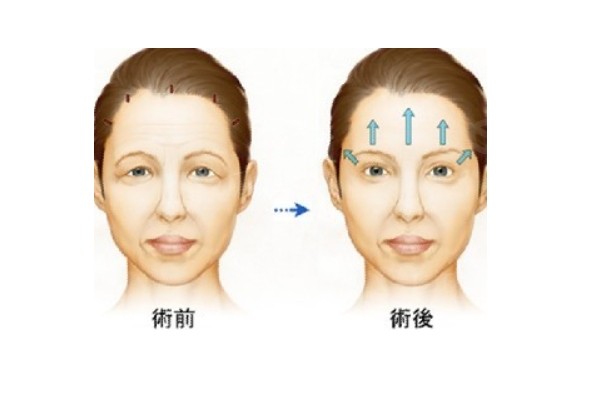 北京哪家做面部拉皮好