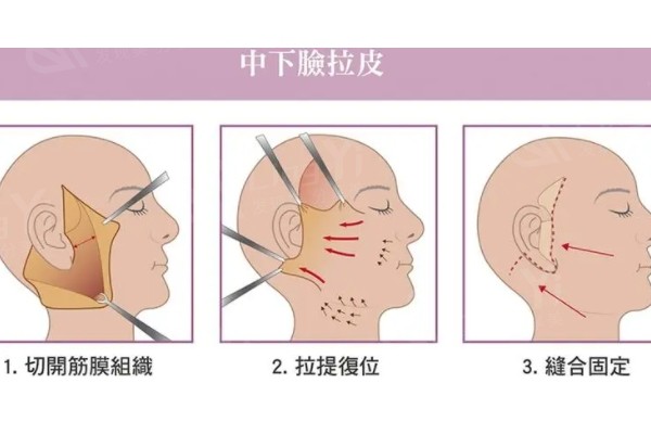 北京哪家做面部拉皮好