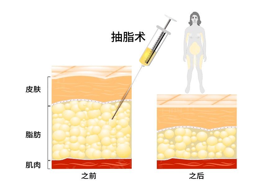 北京东方和谐医院吸脂多少钱