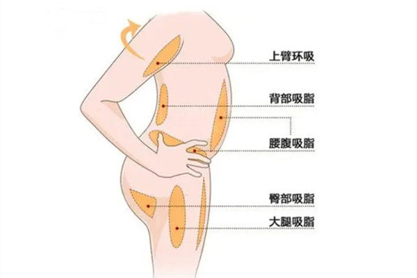 北京东方和谐医院吸脂多少钱？冯斌吸脂技术好单部位吸脂4900元起