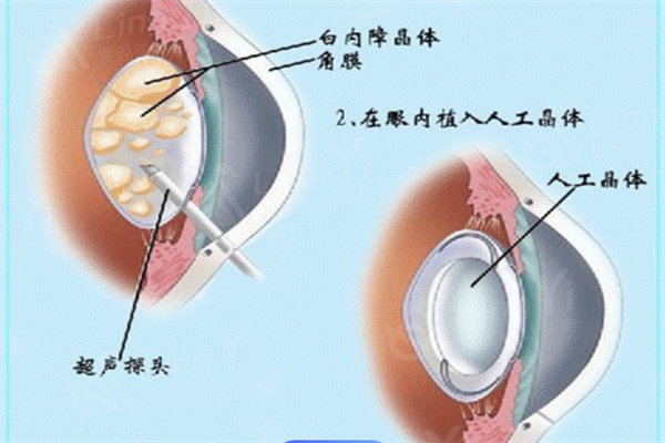 2024白内障人工晶体价格表；单焦/双焦/三焦晶体手术价格各不同