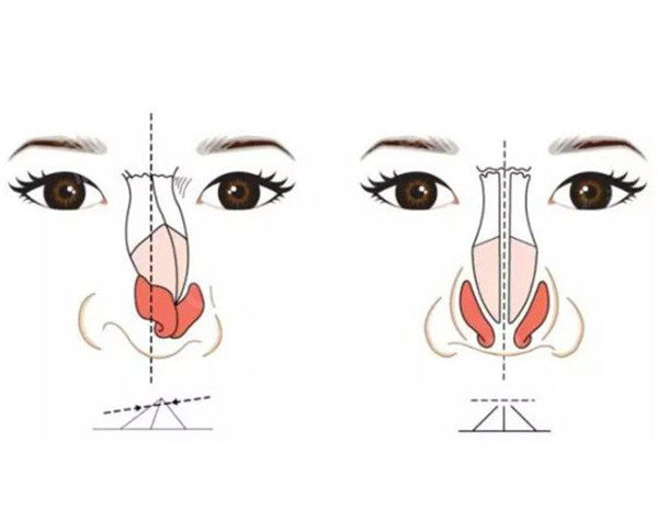 鼻头过宽怎么办？注射缩小鼻头是怎样的过程？