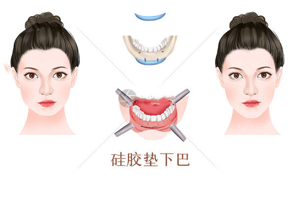上海奥美定取出推荐医生