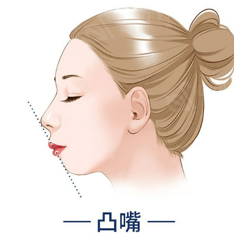 做完短鼻矫正后,您的鼻型变化惊艳了吗?