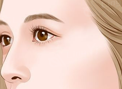 如何做双眼皮手术后，恢复期需要注意哪些事项？