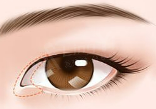 做眼底脂肪重置去黑眼圈,前提要认清这个原因?