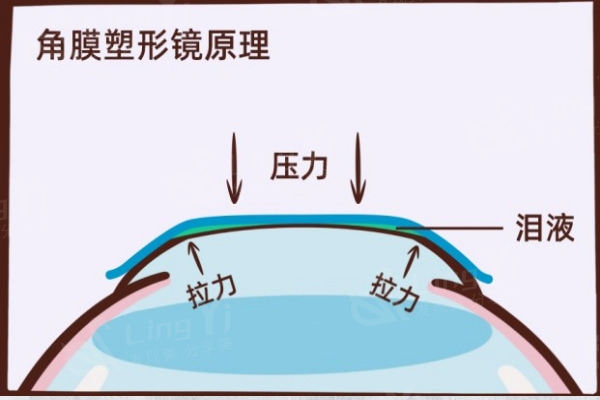 2024角膜塑形镜价格一览表