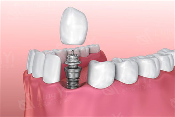 北京劲松口腔医院种植牙价格表