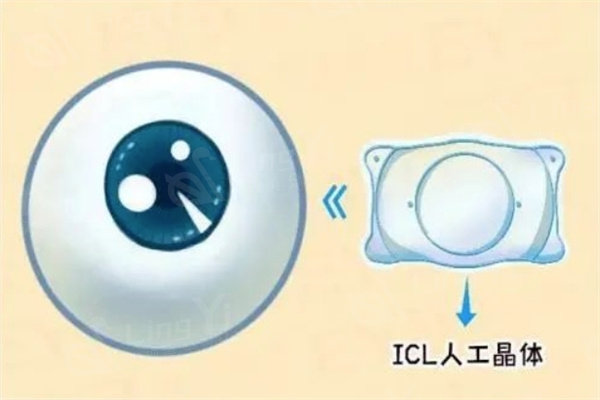 公布武汉做icl晶体植入手术医院排名前十,听说爱尔、自在视、普瑞眼科正规近视手术口碑好