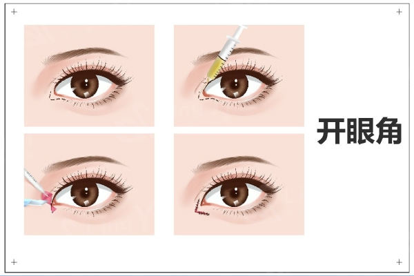 长春整形医院收费标准公开:注射除皱去鱼尾纹|热提拉|自体脂肪填泪沟|去鼻唇沟费用公开