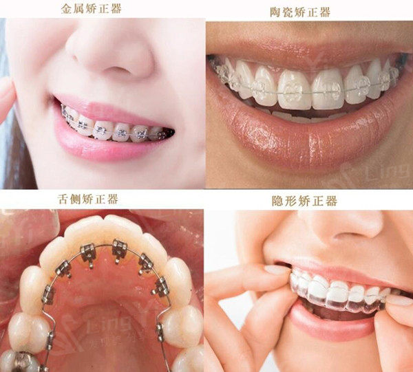 杭州口腔医院收费价目表(20分院通用)：种植牙2980+牙齿矫正6800+
