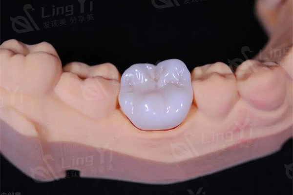 重庆市牙科医院收费标准新版：镶牙860+种植牙2870+矫正5500元起