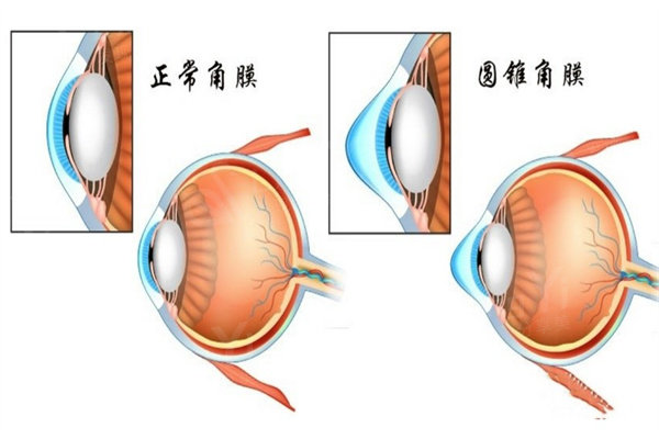 圆锥角膜能做icl人工晶体吗?