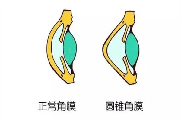 圆锥角膜能做icl人工晶体吗?