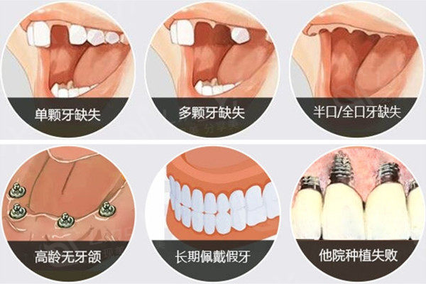 国内种植牙收费价目表：汇总2024年单颗/半口/全口种植体价格表