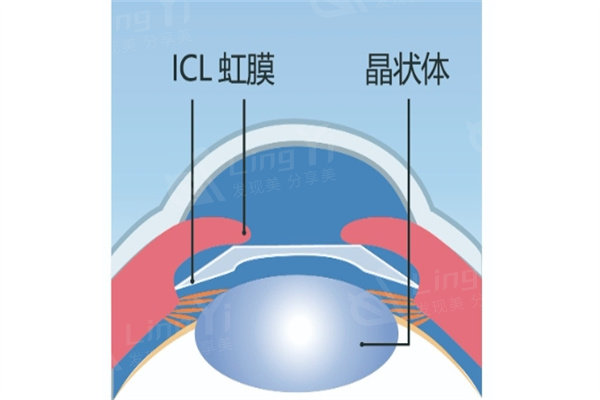 北京东城区近视矫正手术医院排名