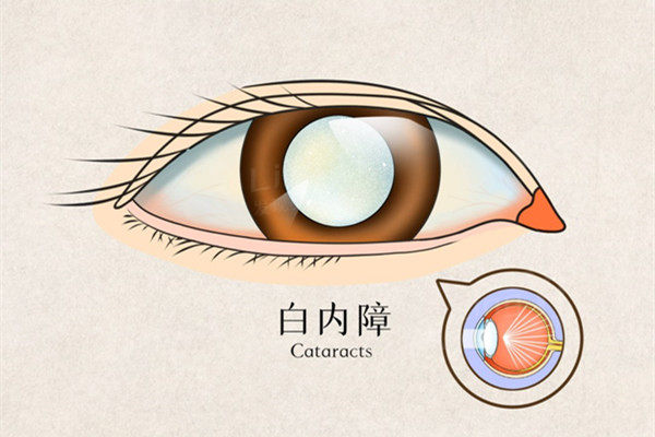 黑龙江有白内障免费政策吗