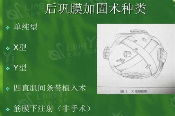 上海做后巩膜加固术好的医生是哪位