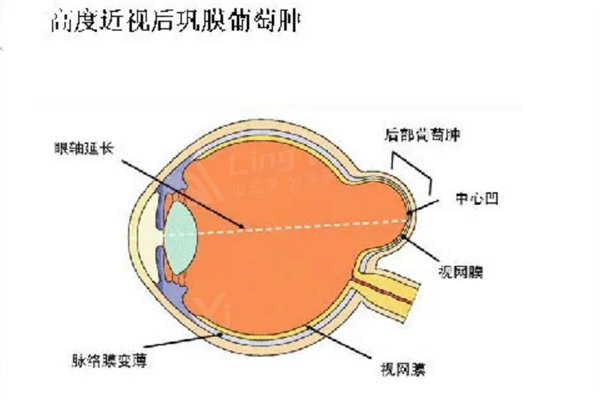 上海做后巩膜加固术好的医生是哪位