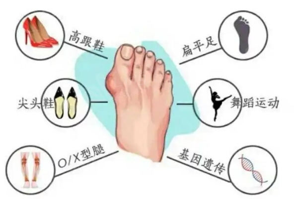 上海虹桥医院大脚骨手术费用更新:单侧矫正13000+价格不贵很实惠