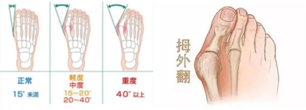 上海虹桥医院大脚骨手术费用更新:单侧矫正13000+价格不贵很实惠