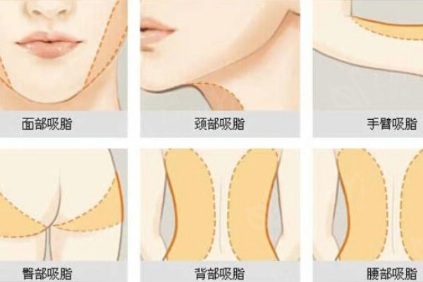 北京达美如艺整形吸脂价格表分享:小腿吸脂3800+腰腹吸脂12800+收费不贵