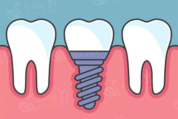 杭州米兰柏羽口腔科种植牙多少钱一颗