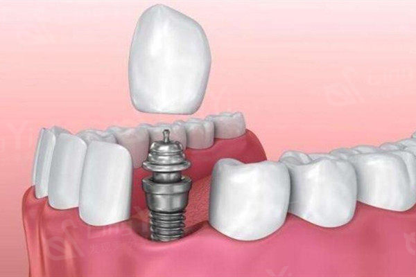 杭州米兰柏羽口腔科种植牙多少钱一颗？进口植体1550元起可以放心选择