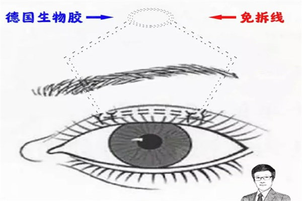 北京美和眼科门诊张丰做小睑裂怎么样