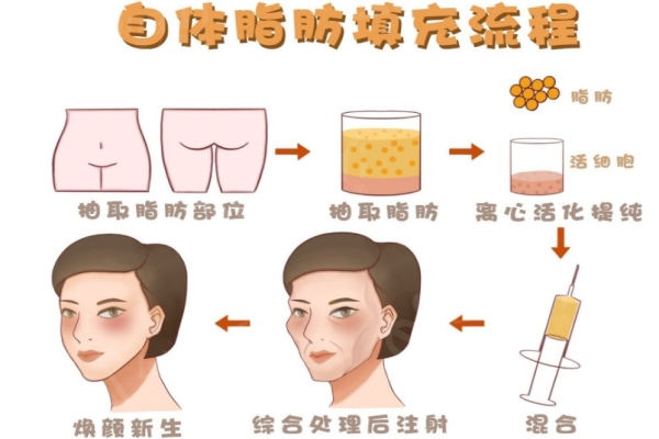 杭州蒋铮铮脂肪填充修复技术好!蒋铮铮做全脸填充价格3万+可维持5年左右