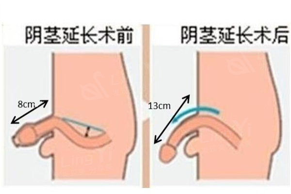 怎样延长阴茎长度？了解阴茎延长手术原理图解方法及男性增粗延长手术收费价格