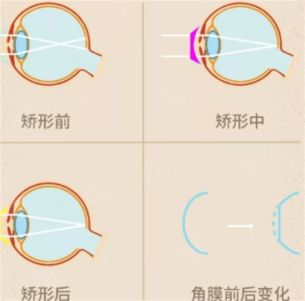 青岛老视眼科医院排名前4 其中青岛华厦和鹿晰口碑又技术也不赖