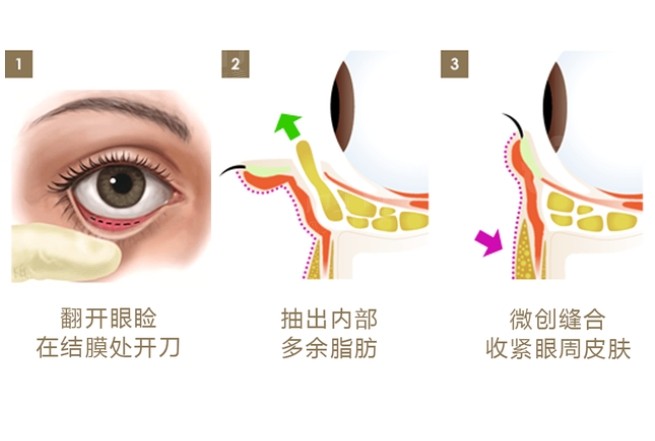 美诗沁去眼袋怎么样？