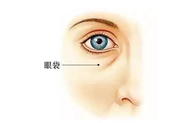 不开刀祛眼袋哪里可以做？上海美诗沁整形不开刀祛眼袋效比较有名