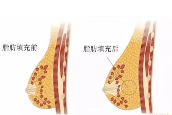 25年版武汉隆胸做得好的医院推荐，实力派医院名单揭晓啦快来看