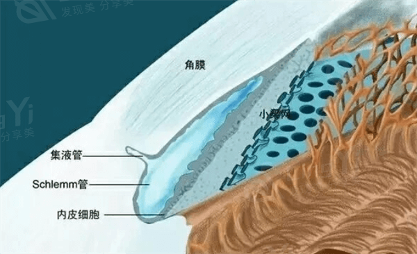 视网膜脱落风险高，全飞秒半飞秒手术助力高度近视人群重获清晰视力