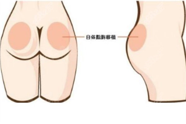 王自谦做丰臀多少钱?脂肪填充蜜桃臀价格7.9w起存活率高